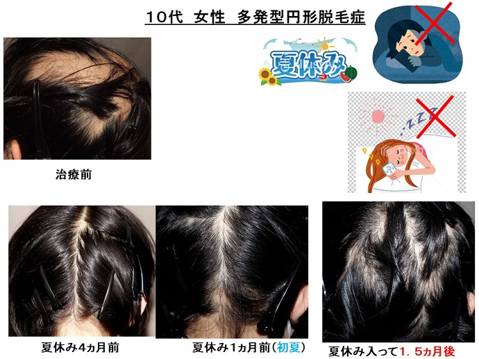 円形脱毛症　病院